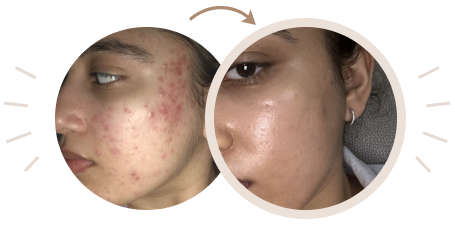 Acne before and after